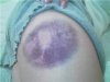 Bruise.jpg