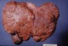 cirrhotic liver.jpg